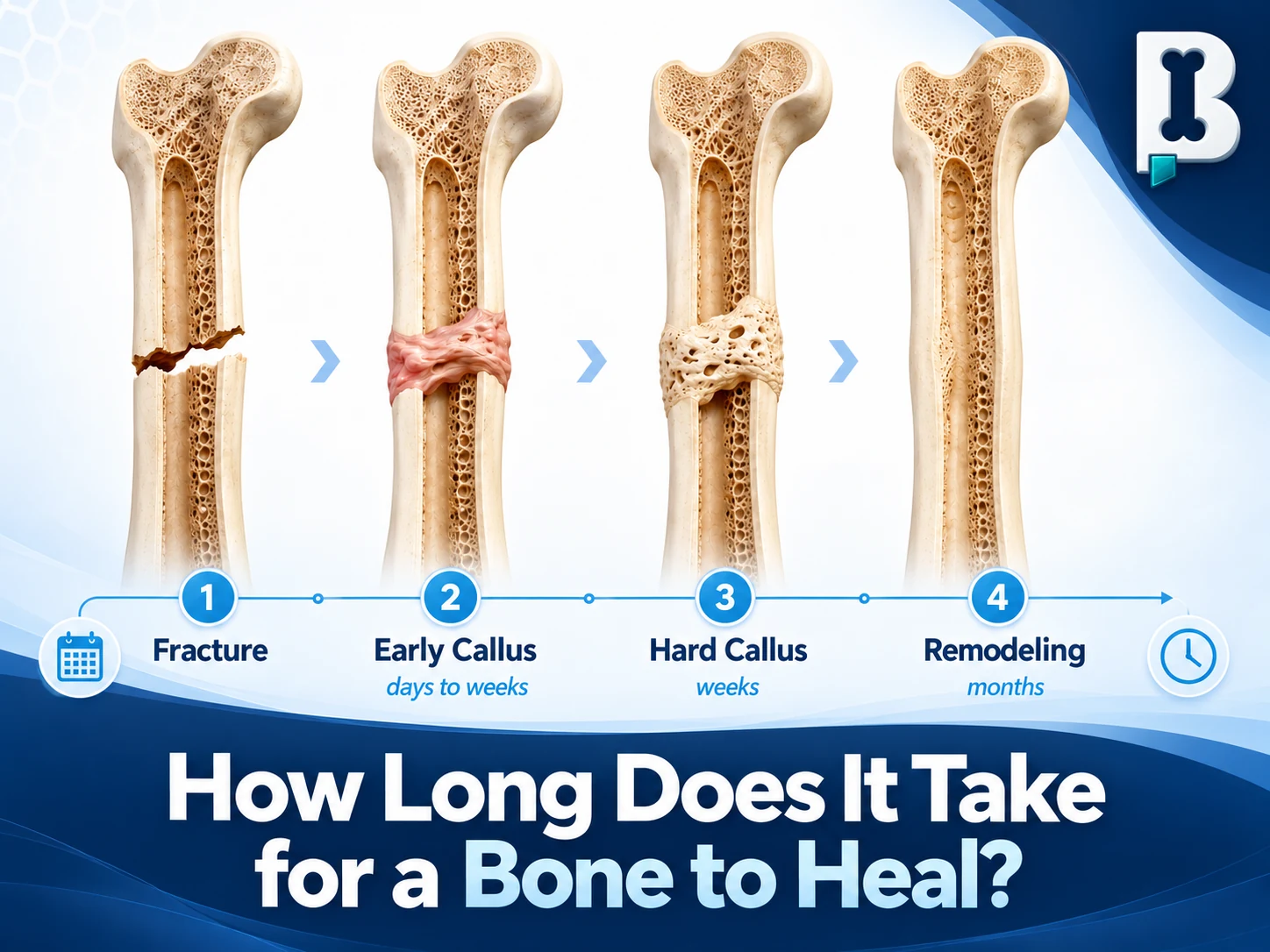Illustration showing stages of fracture healing — fracture, early callus, hard callus, and remodeling.