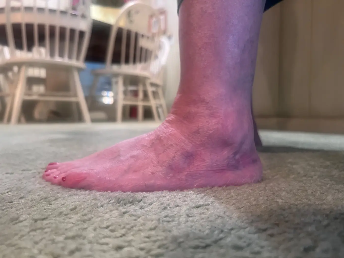 Dr. Barnes’s mother’s ankle, showing a faint healed incision along the outside of the distal fibula
