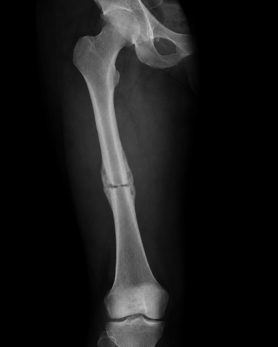 X-ray showing a femoral shaft fracture with early callus formation.