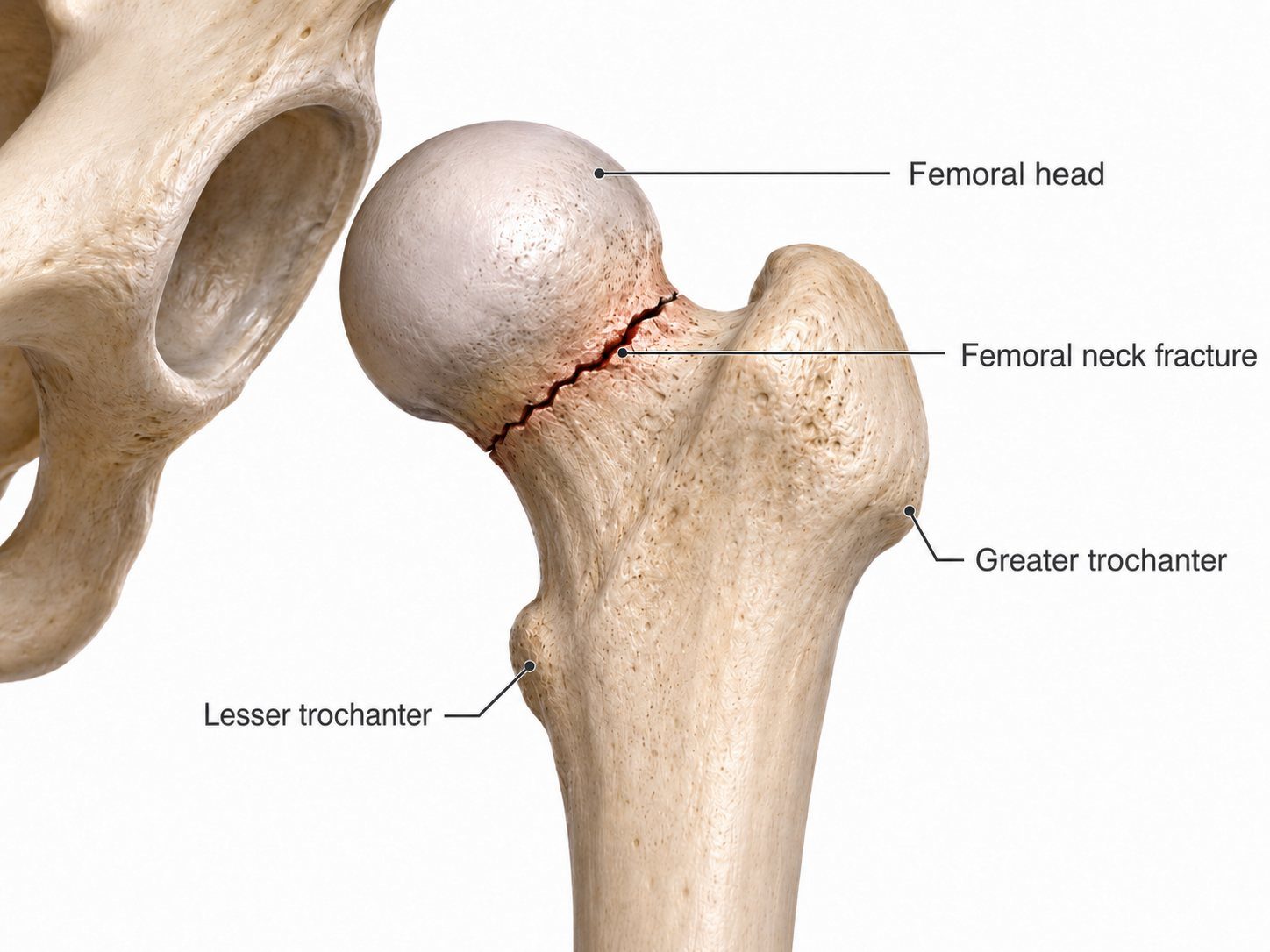 Femoral neck fracture diagram