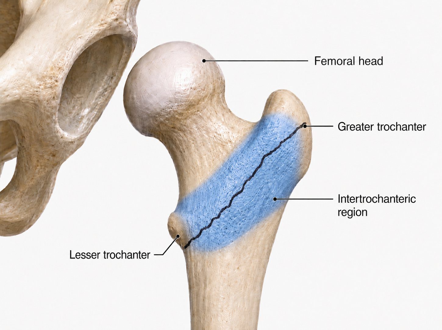 Intertrochanteric fracture region